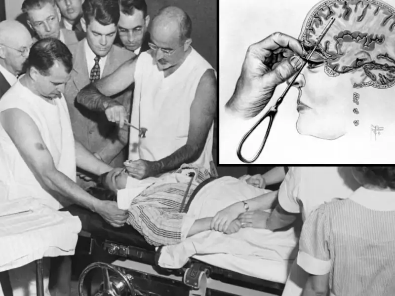 Lobotomy: A Dark Chapter in the History of Mental Health
